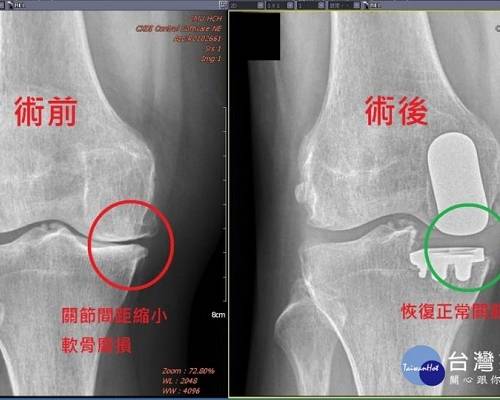 中天新聞報導 醫療新科技「機械手臂」置換人工關節