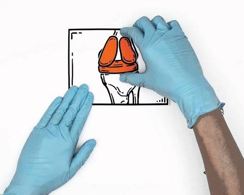 退化性關節炎治療新方法，MAKOplasty® 機器人手臂關節置換- 民眾解說篇