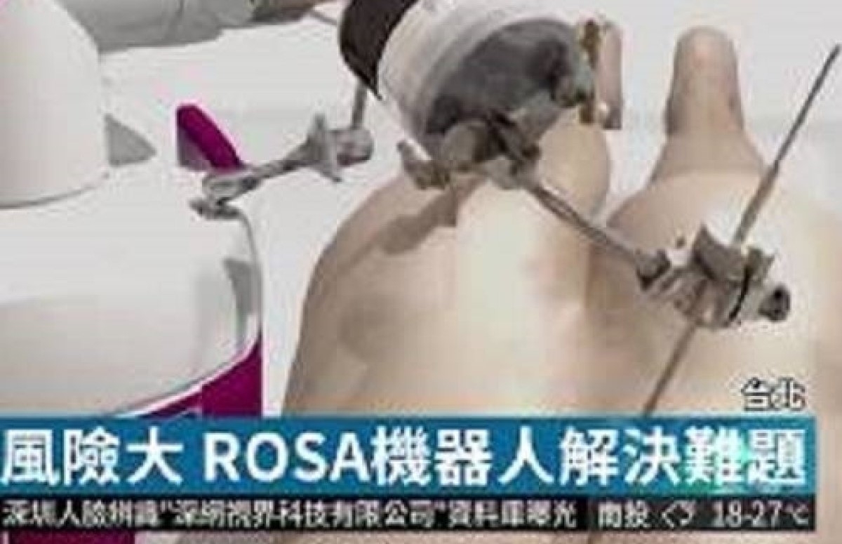 【華視新聞】全台唯一ROSA機器人 助脊椎手術更精準