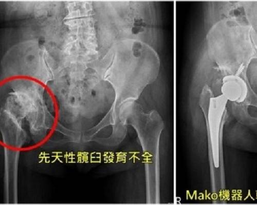 【UHG醫療新聞】先天髖臼發育不全 機器人輔助手術助她正常行走