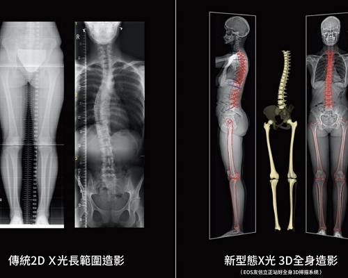 【UHG醫療新聞】X光檢測技術再創新　新型「EOS」輻射量較傳統減少50%